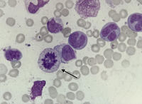 Mitosis in a bone marrow aspirate