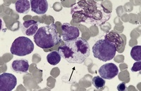 Mitosis in a bone marrow aspirate-3