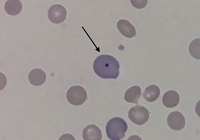 Howell-Jolly body
