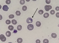 Pappenheimer bodies