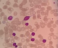 Giant lymphomatous cell (in a patient with splenic marginal zone lymphoma