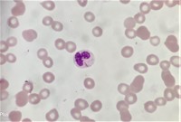 Auer rod in neutrophil