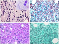 Mycobacterium avium-intracellulare complex staining GMS and PAS-D