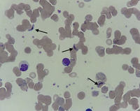 Malaria: Gametocyte of Plasmodium Falciparum