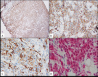 Myeloid-Sarcoma-immunostains