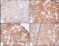Myeloid-Sarcoma-immunostains