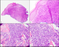 Myeloid Sarcoma, H&E