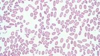 Hereditary elliptocytosis