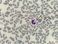 Hereditary Elliptocytosis