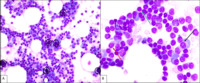 Lymphoplasmacytic lymphoma - Bone marrow aspirate