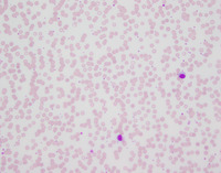 Lymphoplasmacytic lymphoma - Peripheral blood