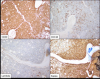 Lymphoplasmacytic-lymphoma--IHC