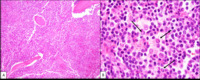 Lymphoplasmacytic lymphoma - Bone core biopsy