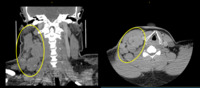 Classical Hodgkin lymphoma - CT scan