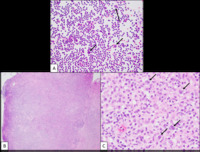 Classical Hodgkin lymphoma - H&E