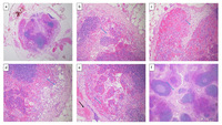 Vascular transformation of lymph node sinuses