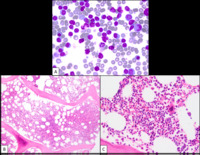 Chronic-lymphocytic-leukemia