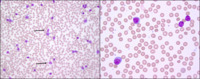Chronic-lymphocytic-leukemia