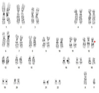 Chronic lymphocytic leukemia - Trisomy 12