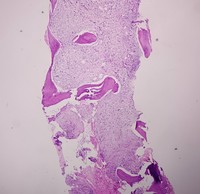 Bone marrow fibrosis