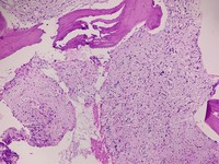 Fibroblastic proliferation in high power view