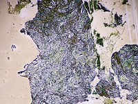 Reticulin stain grade 2 -3 fibrosis