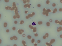 Bluish background staining in multiple myeloma peripheral blood film 1