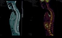 PET CT-Bone marrow