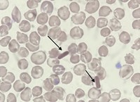 Hemoglobin C Crystals