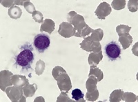 Hairy cell
