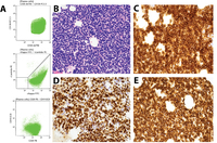 Atypical Presentation of a Small-Cell Subtype Multiple Myeloma with High Expression of CD20 and BCL1