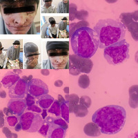 Xeroderma pigmentosum and acute myeloid leukemia: a case report