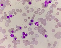 autoagglutination in a case of auto immune hemolytic anemia