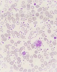 Essential thrombocythemia