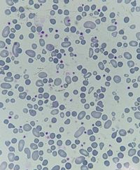 Poikilocytosis