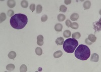 Acute Promyelocytic Leukemia