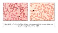 The “Pincers” Of Haemolysis