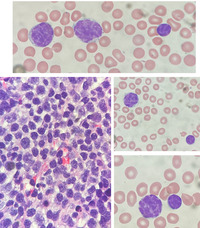 Large Cell Transformation of CLL: Peripheral Blood Smear Findings