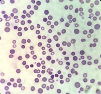 Hereditary spherocytosis