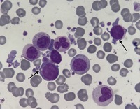 Acute Megakaryoblast Leukemia