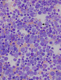 Bone-Marrow-Aspirate-at-low-power