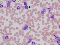 Peripheral blood smear