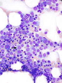 Blastic Plasmacytoid Dendritic Cell Neoplasm (BPDCN) involving marrow