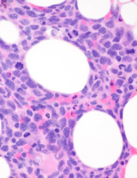 Bone marrow biopsy at high power