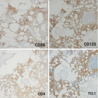 Marrow-biopsy-Immunohistochemistry