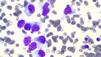 Metastatic lung cancer