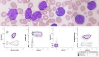 CD10-Positive Blastoid Variant of Mantle Cell Lymphoma