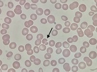 Mushroom- shaped red blood cell