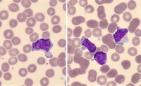 Infectious mononucleosis