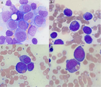 Erythrophagocytosis in AML with t(8:16)